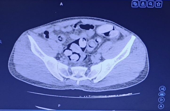Midesinden 1 kilo uyuşturucu çıktı
