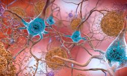 Araştırmacılardan Alzheimer'a karşı yeni yöntem