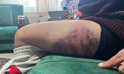 Vicdanları yaralayan olay: Otizmli şahıs odunluğa baktı diye odunla darbedildi