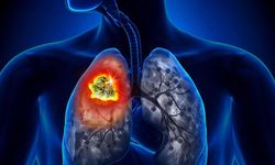 Akciğer kanserinde erken teşhis ve cerrahi müdahale hayat kurtarıyor