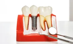 İmplant SSK kapsamına giriyor