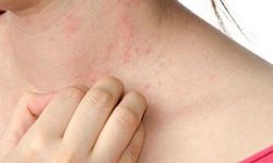 Uzmandan kurdeşen uyarısı!