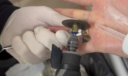 Batman’da parmağa sıkışan iki yüzük ’spiral makine’ ile çıkarıldı