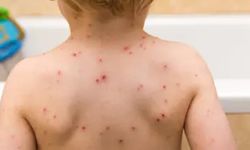 Okullarda "suçiçeği" alarmı: Sessizce yayılıyor, belirtilere dikkat!