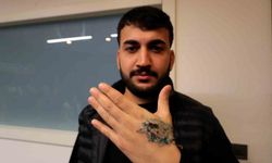 Dövme sildirmek isterken kabusu yaşadı, elindeki dokular öldü