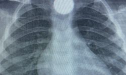 Bursa'da küçük çocuğun boğazına 50 kuruş kaçtı