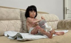 Bursa’da 4 yaşındaki İbrahim’in 'kelebek hastalığı' hayatını zorlaştırıyor