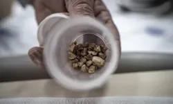 Bir kadının idrar kanalından 51 taş çıkarıldı