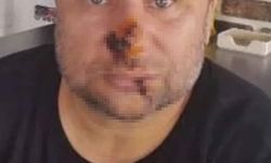 Ünlü şarkıcının yüzü çürümeye başladı!