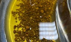 Safra kesesinden 2 bin 67 taş çıkarıldı