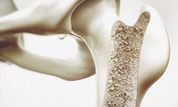 Sessiz ilerleyen hastalık: Osteoporoz