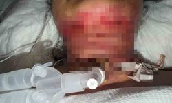 Gıdı estetiği sonrası nefes alamadı, boynundan acil solunum yolu açıldı