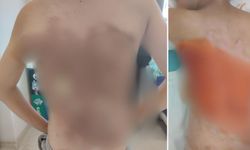 12 yaşındaki çocuğun sırtını kolonya döküp yaktılar! 25 gün hastanede kaldı