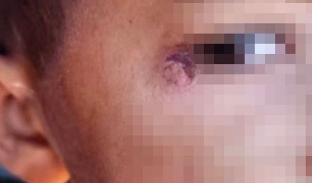 Öğrencinin yüzünde sigara söndüren temizlik görevlisi tutuklandı