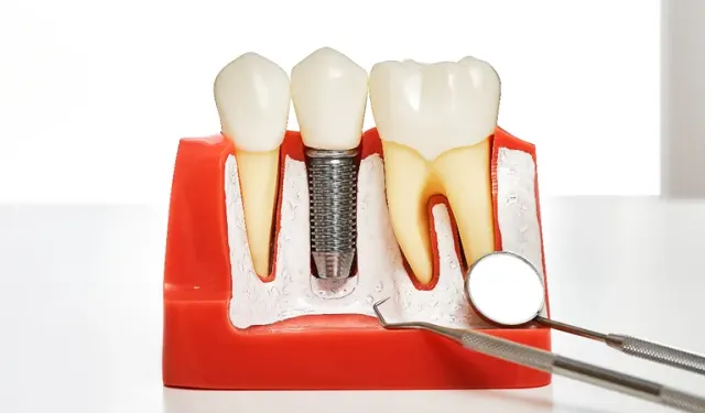 İmplant SSK kapsamına giriyor