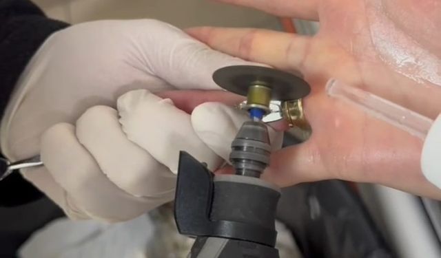 Batman’da parmağa sıkışan iki yüzük ’spiral makine’ ile çıkarıldı