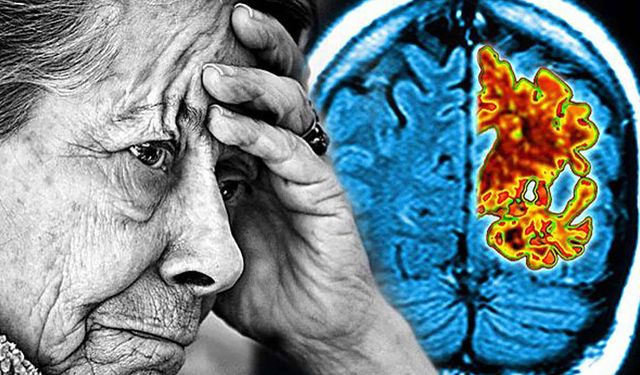 Tıpta çığır açan gelişme: Alzheimer tedavisinde umut ışığı