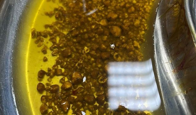 Safra kesesinden 2 bin 67 taş çıkarıldı