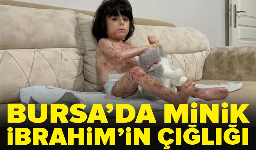 Bursa’da 4 yaşındaki İbrahim’in 'kelebek hastalığı' hayatını zorlaştırıyor